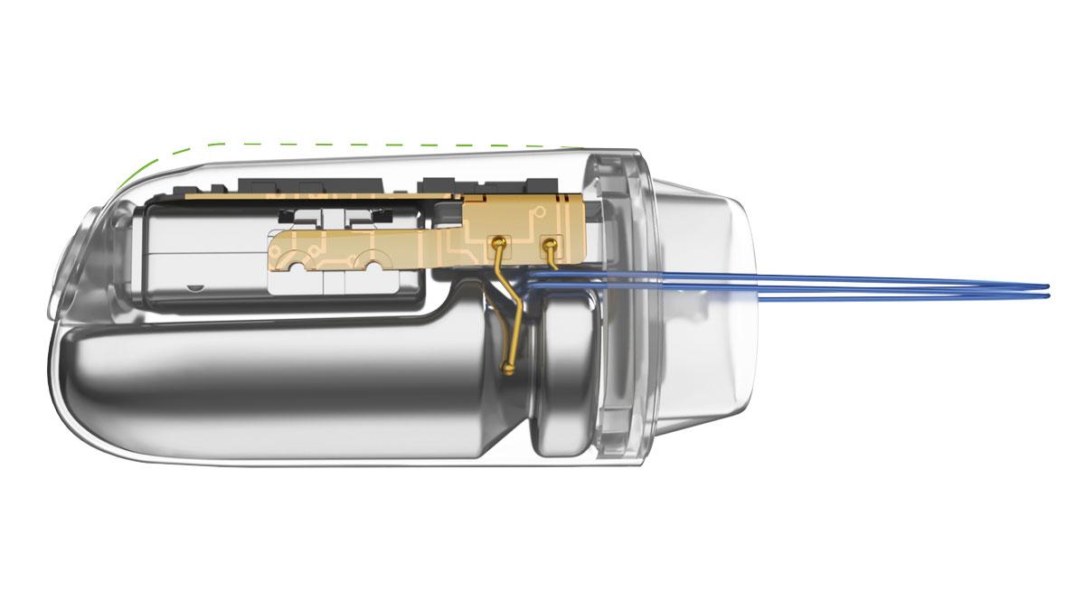 Audiologist Reviews the Invisible Lyric Hearing Aid